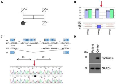 Hermansky-Pudlak Syndrome: Identification of Novel Variants in the Genes HPS3, HPS5, and DTNBP1 (HPS-7)